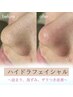 《★8月限定★》気になる毛穴を徹底改善 毛穴洗浄（ハイドラ）¥12000→¥3980