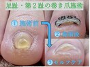 足趾の第2趾の施術