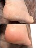 フットケア◇かかと角質ケア＋保湿ケア