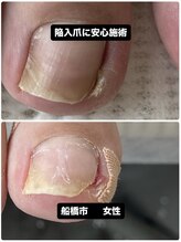 巻き爪じゅん 千葉駅前店/陥入爪の痛みが改善！