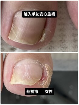巻き爪じゅん 千葉駅前店/陥入爪の痛みが改善！