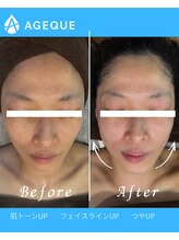 アジーク 町田店(AGEQUE)/たるみリフトアップ