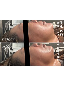 ホウレイ線・たるみ改善！予防ケア