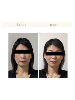 ミヤビ(miyabi)/小顔矯正