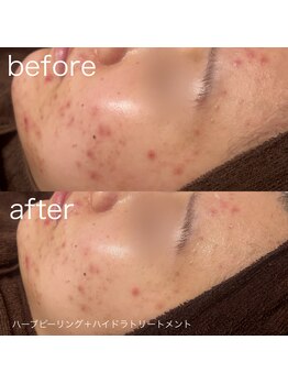 ルルラ リコ(lulula rico)/症例写真/ハーブピーリング