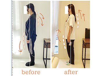 整体院ひなた 宮崎院/反り腰猫背が良くなりました！