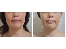 ヨサパーク モックス 堺東(YOSA PARK MOX)/30代後半　小顔　週2　3カ月