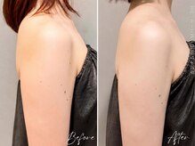 キラビューティー 二子玉川店(KIRA Beauty)の雰囲気（最新カンナムリフトB/A二の腕・小顔・たるみ・痩身・むくみ）