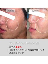 リファラ 光の森店(REFALA)/毛穴・ニキビケア専門REFALA