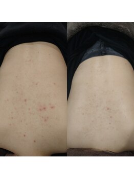 ボーソリューション(Beau-Solution)/【30代　背中肌荒れケア】