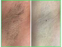 クリア 尾張旭店(Clear)/【Clear脱毛ビフォーアフター】