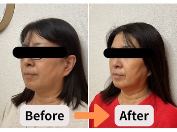 ブプラ 池田店(BUPURA)/小顔 たるみ 歪み ほうれい線