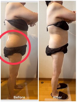 ルミナス/Frozen Philippe脂肪冷却コース