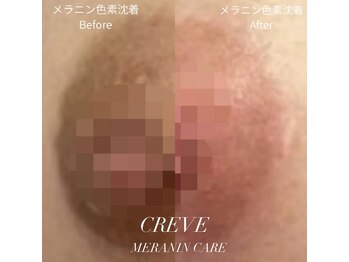 クレーヴ(CREVE)/韓国最先端技術