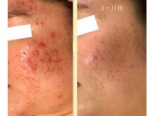 ローズ 下松(ROSE)/プラズマケア＋光フェイシャル