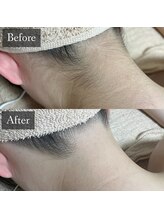 ベルフィーヌ 恵比寿店(BELFINE)/うなじ・襟足脱毛でうしろ姿美人