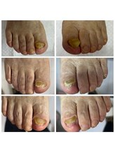 ドクターネイル爪革命 十条店/肥厚爪ケア