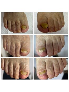 肥厚爪ケア