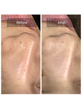 ピネ(pine)/Before After