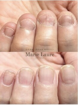 マリーロール 天王寺店(Marie Laure)/自爪育成/深爪矯正/ネイルケア