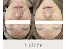 フォルチェ ゆめタウン広島店(Folche)/肌質改善/根本にアプローチ