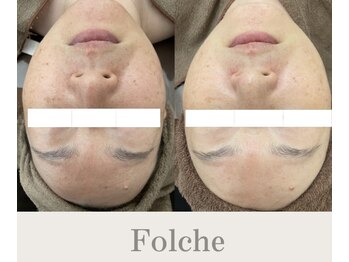 フォルチェ ゆめタウン広島店(Folche)/肌質改善/根本にアプローチ