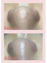 エヌ ドット ジュウイチ(N.11)/毛穴エクストラクション