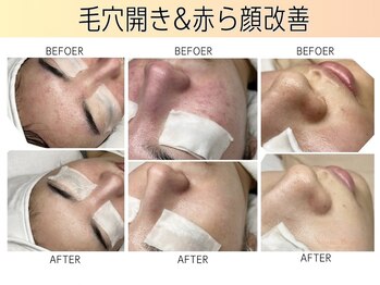 シャイニングビューティー 表参道(Shining Beauty)/敏感肌・赤ら顔改善