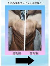 レガ(LEGA)/お顔のたるみ改善♪