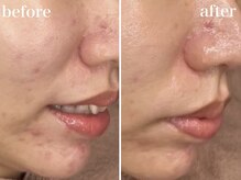 ホワイトアクア 錦糸町店(WHITE AQUA)/ララピール/毛穴/錦糸町