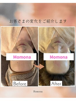モモナ(Momona)/フェイシャルエステbefore after