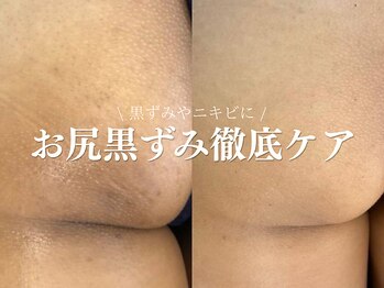 ルアナアイナ 大分/ハーブピーリング(11)