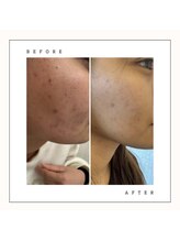 サロン ルピア(salon Lupia)/DT無しハーブピーリング