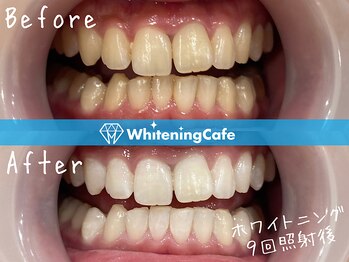 ホワイトニングカフェ 松本店(WhiteningCafe)/ホワイトニングビフォーアフター