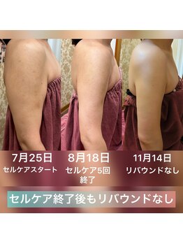 ヴィクトワール シュエット/【二の腕集中痩身】40代のお客様