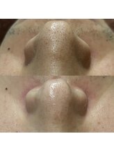 ユウユウ(YUYU)/毛穴洗浄