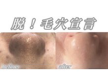 サロンデュ ひゃーく(Salon du ひゃーく)/～気になる毛穴～