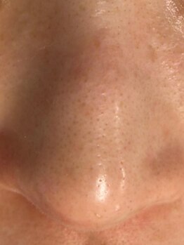 リチア(RICHIA)の写真/毛穴の黒ずみ、乾燥が気になるお肌に◎オールハンドマッサージの贅沢エステで思わず触りたくなるお肌へ…♪