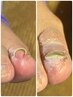 巻き爪矯正１趾