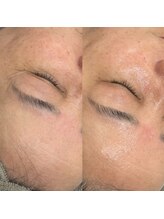 フルミー(fulme.)/ハーブピーリングbefore＆after