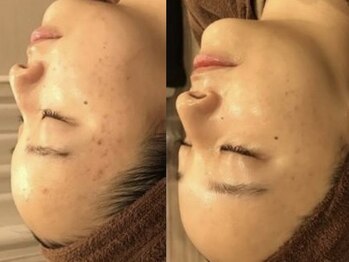 ヴィヴァンビー(Vivant+B)/before /after