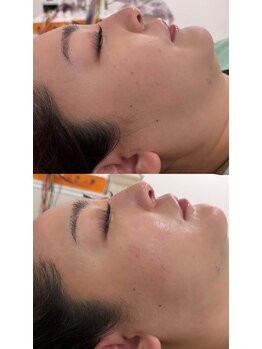 マホロバ(mahoroba)/ダーマ鍼幹細胞導入