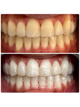 コナホワイトニング 神保町/ホワイトニング