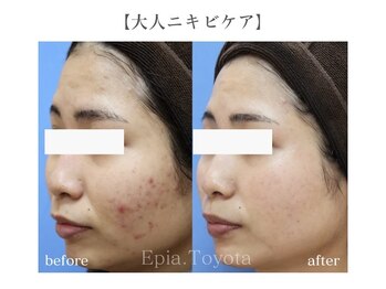 エピア 豊田店(Epia)/大人ニキビケア・赤み痕ケア