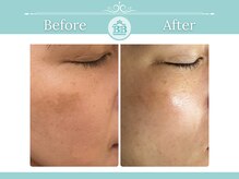 シミケアゼロ美人 表参道店(シミケアZERO美人)/【シミケア/シミゼロ症例】