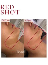 パリス 七尾店/レッドショット☆輪郭形成施術