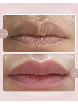 ドクターメラニン ラボ トーキョー 渋谷(Dr. Melanin Labo TOKYO)/唇メラニンケア症例