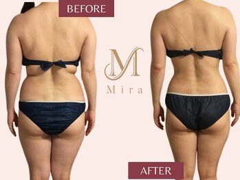 ミラ 札幌店(Mira)/【痩身】ハイパーナイフ