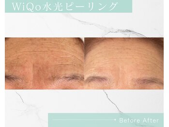 リノア 柏(Lino'a)/50代～の深いしわ◎WiQoで肌改善