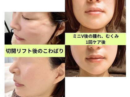 インディバ ミマリ(INDIBA ミマリ)の写真
